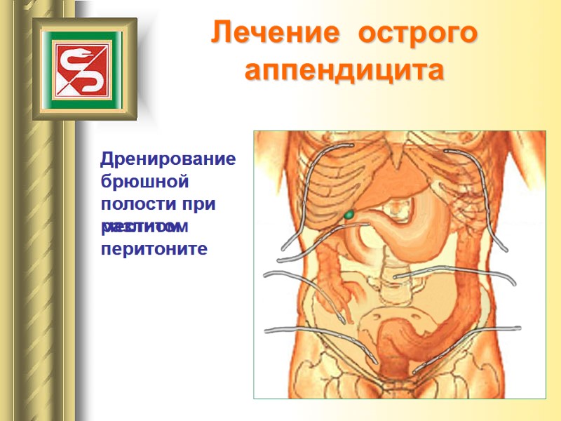 Лечение  острого  аппендицита Дренирование брюшной полости при местном перитоните Дренирование брюшной полости